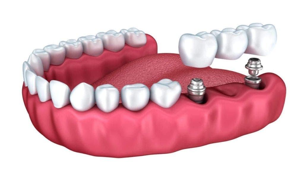 Things to know about dental implants, Dental Implant Info